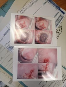 Having a Colposcopy - photos of what happened during the procedure.